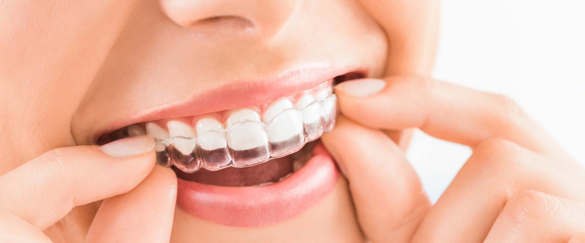 How is invisalign done?
