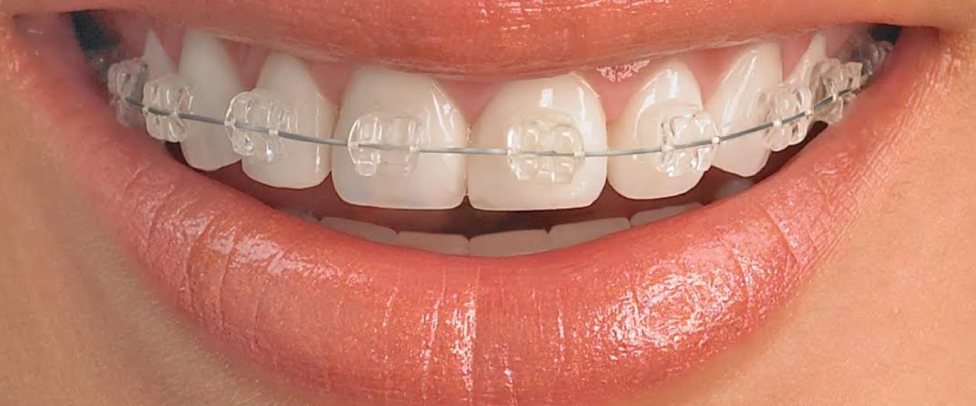 Is invisalign better than traditional?