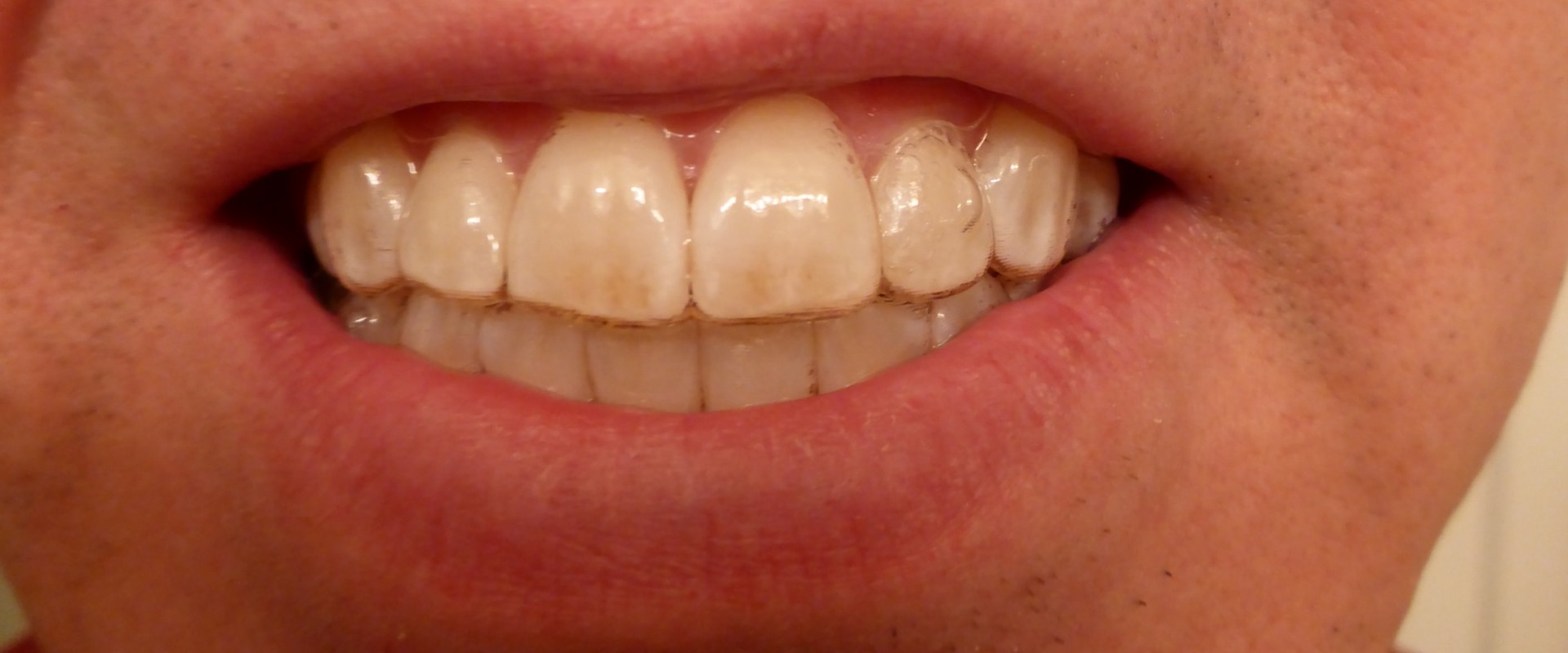 Can Invisalign Damage Your Teeth?