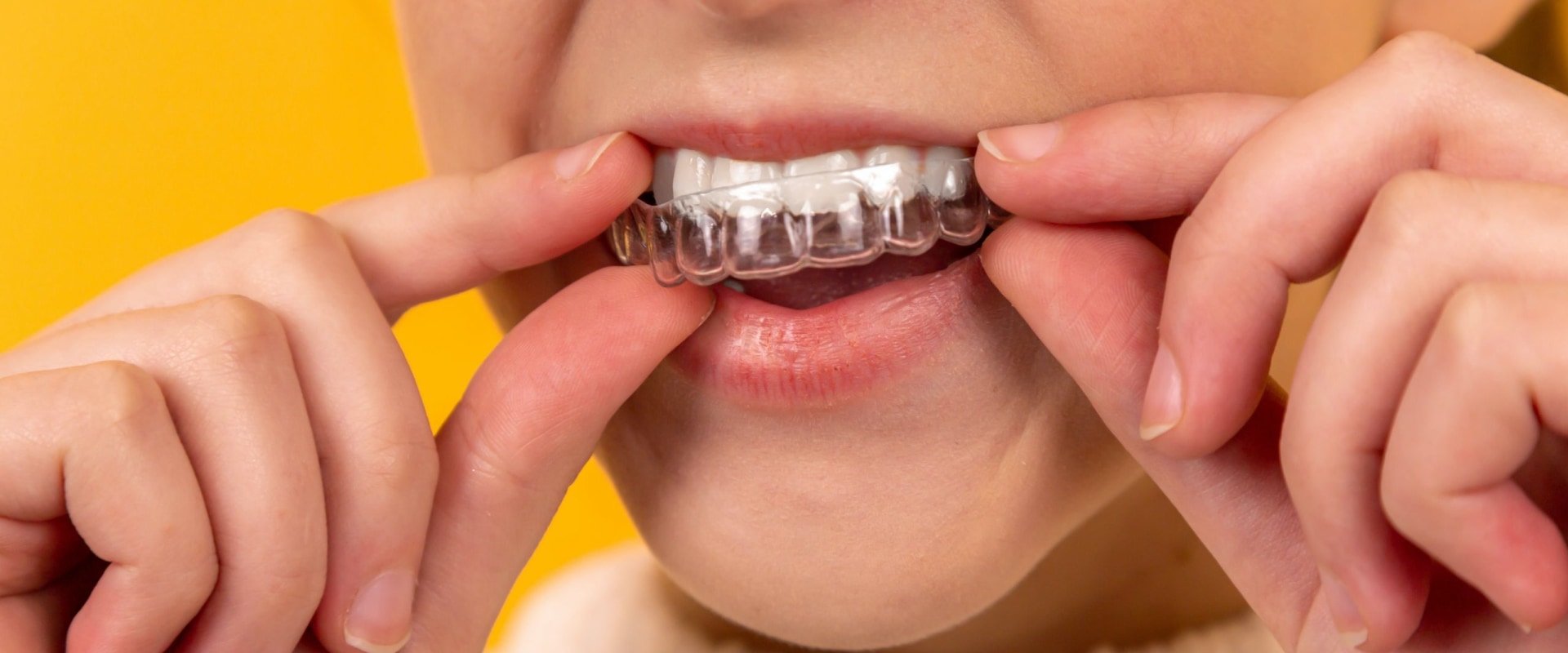 Is invisalign better or better braces?