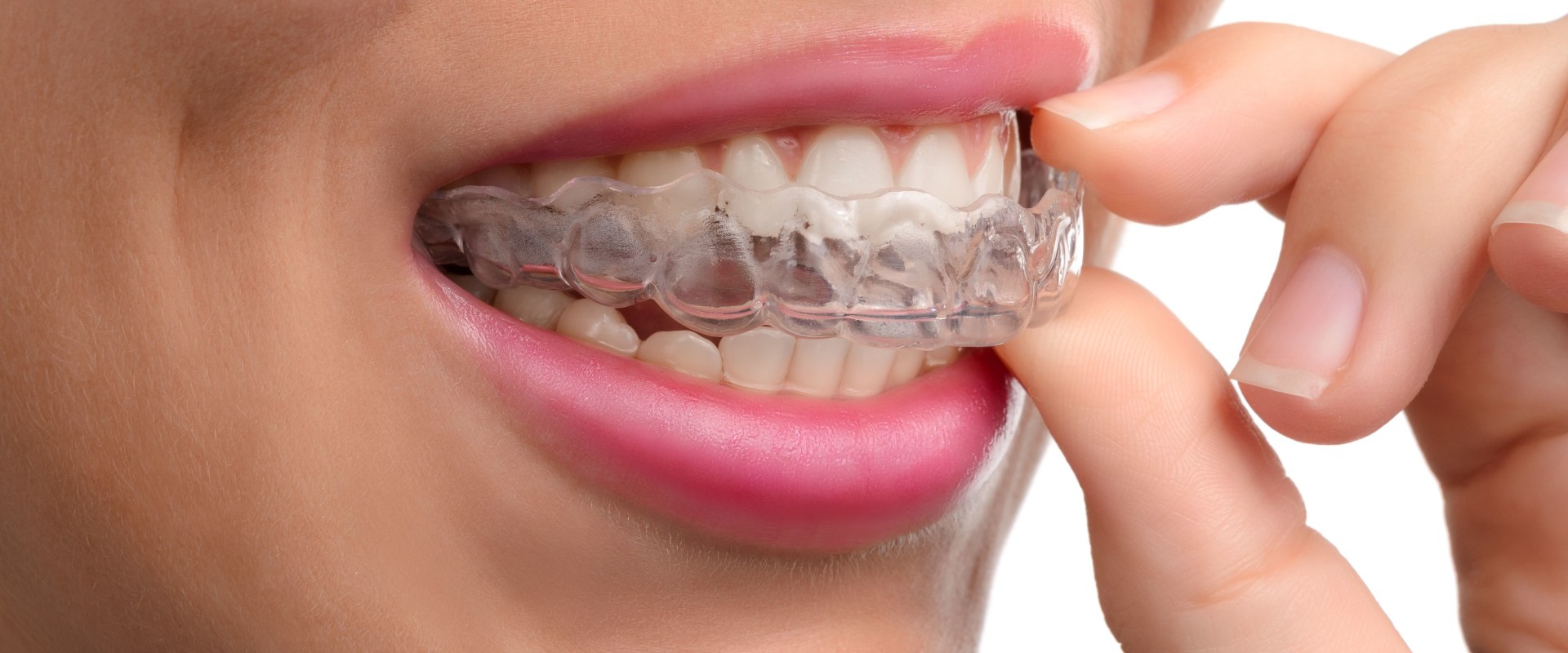 How long is invisalign supposed to last?