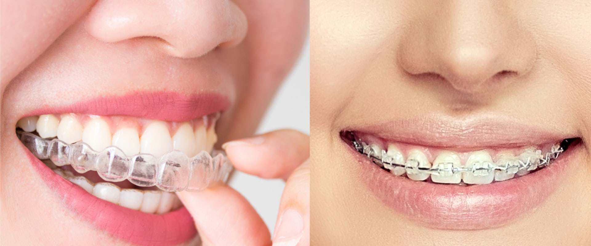 Is it better to wear braces or invisalign?