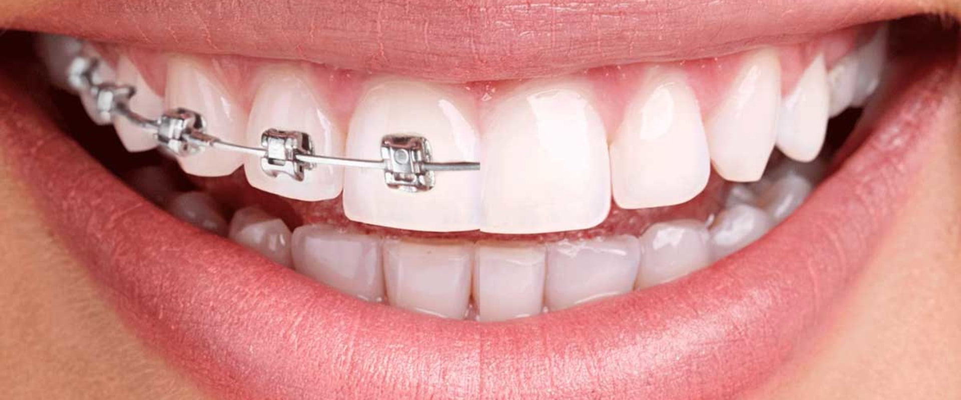 What are the most effective braces or invisalign?