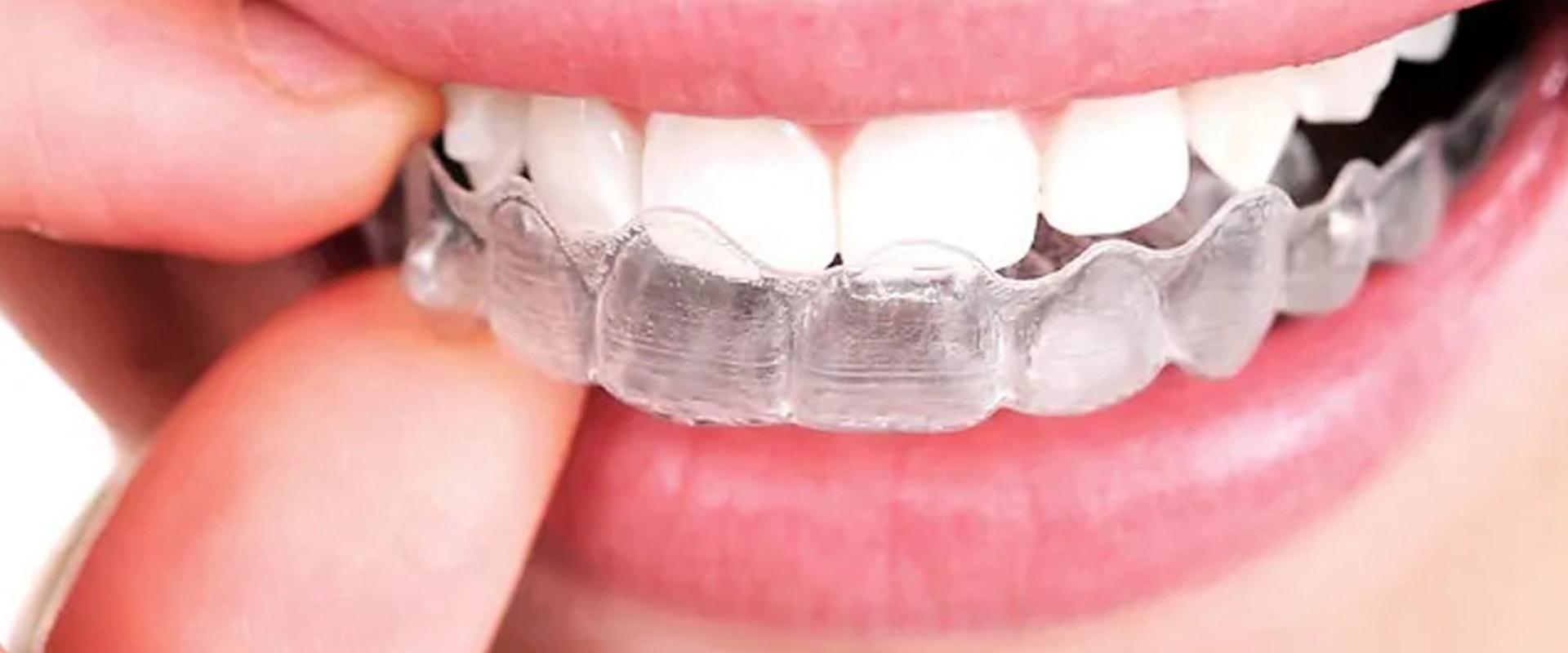 How much should I expect to pay for invisalign?