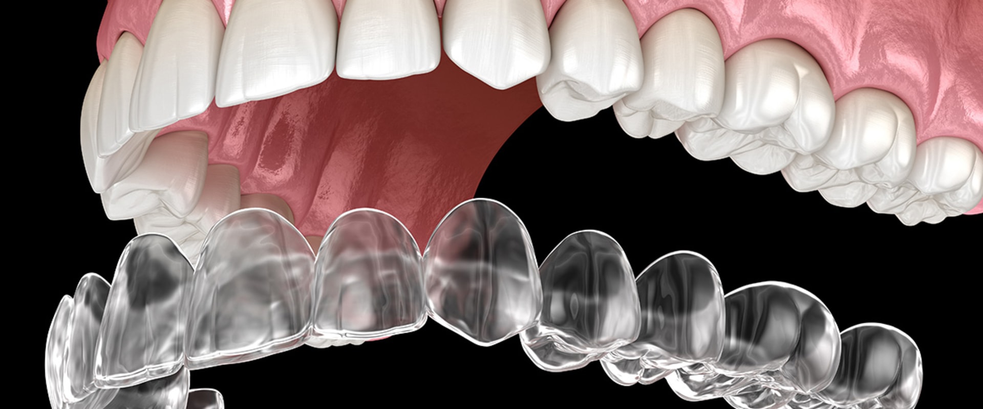 Why is invisalign more expensive?