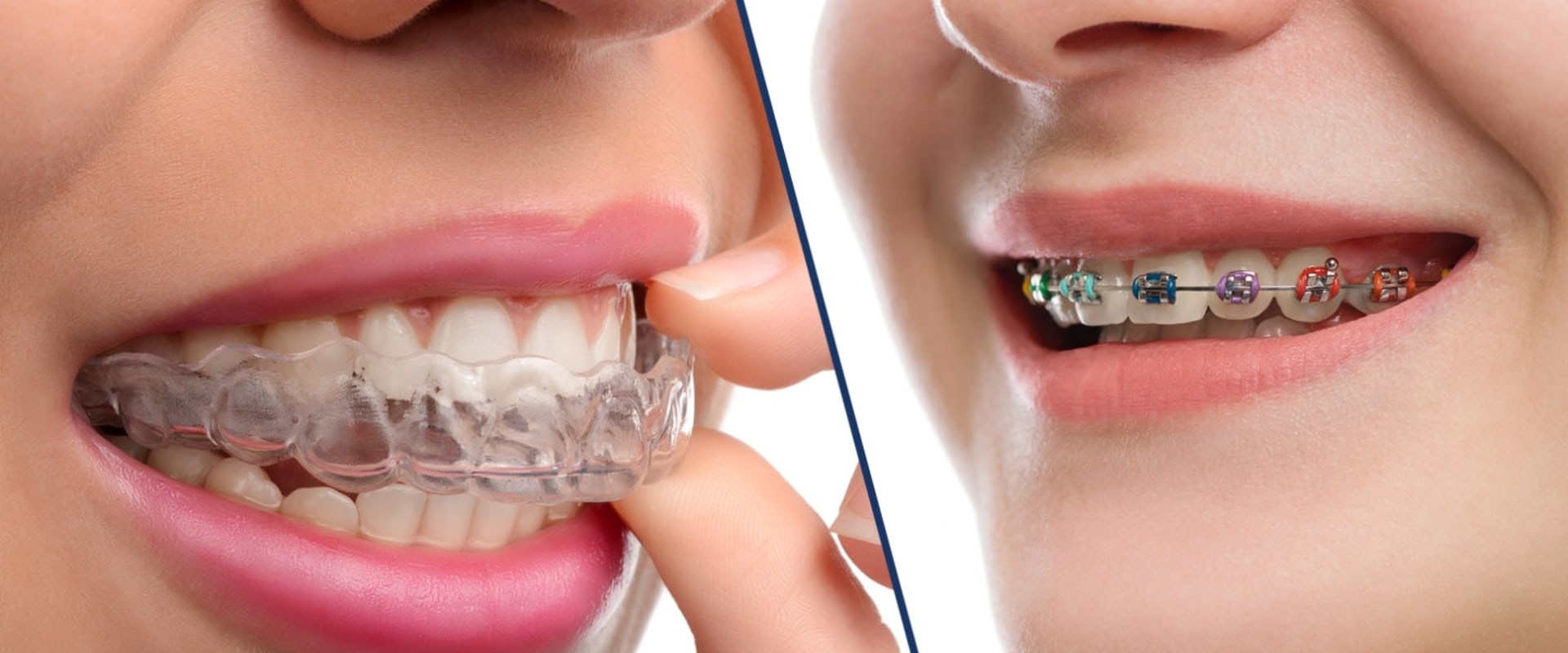 Why is invisalign more expensive than braces?
