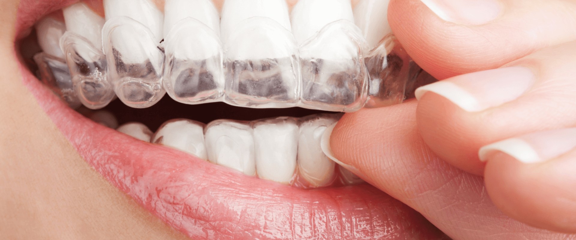 Can you choose whether you want braces or invisalign?