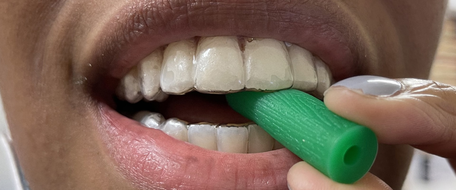 How should invisalign fit in?