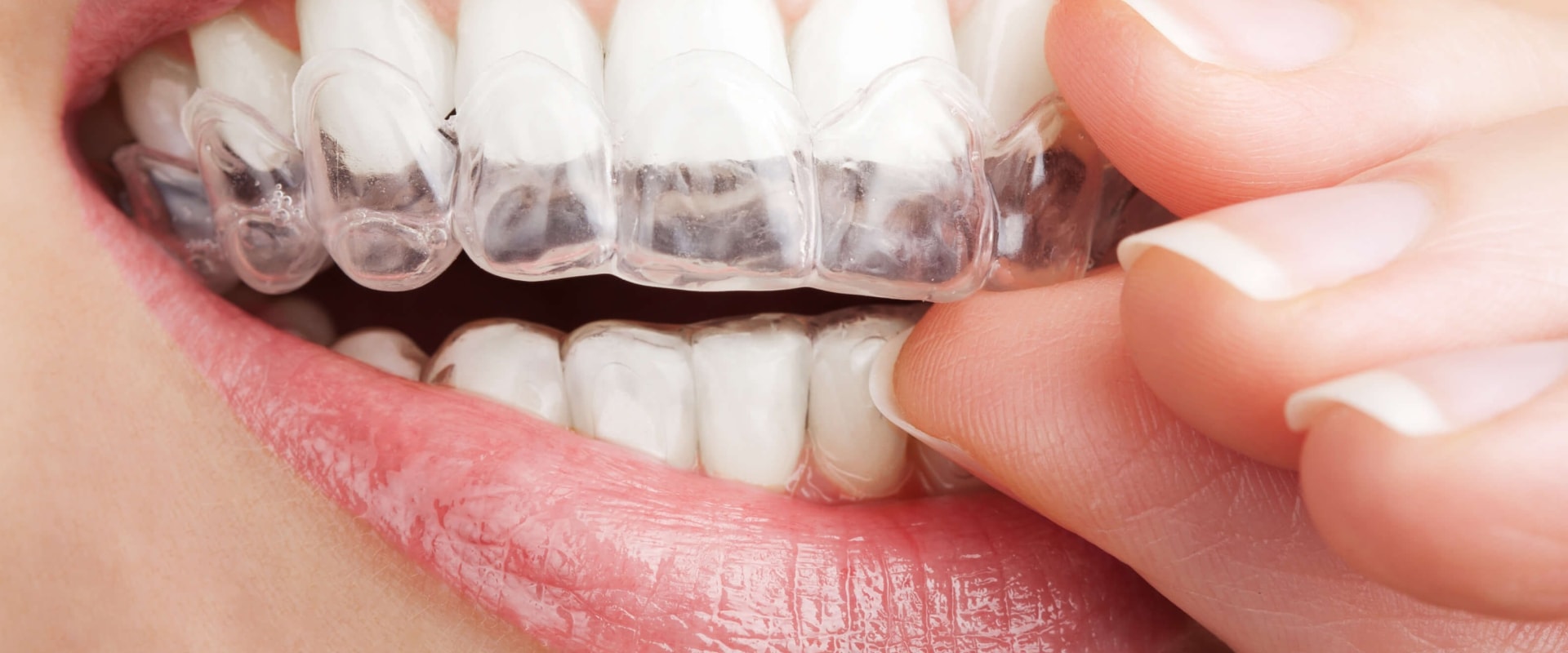 What can invisalign fix?
