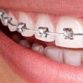 Why does invisalign take less time than braces?