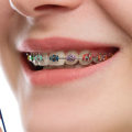 Which is cheaper braces or invisalign?