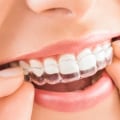 What does invisalign do?