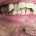 Invisalign who is not a candidate?
