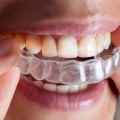 Is it cheaper to get braces or invisalign?