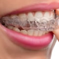 How long is invisalign supposed to last?
