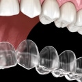 Why is invisalign more expensive?