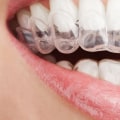 Does invisalign give the same results as braces?