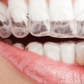 Which are faster keys or invisalign?