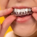 Which one works faster braces or invisalign?