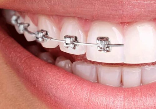 Why does invisalign take less time than braces?