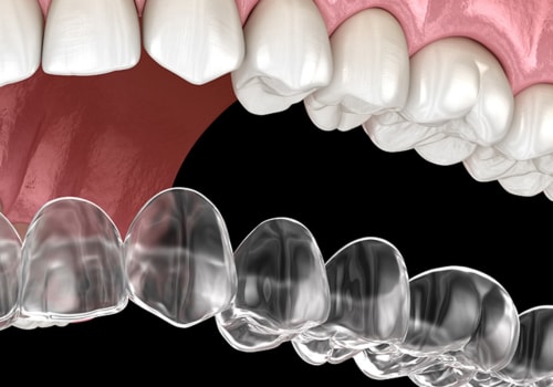 Why is invisalign so expensive?