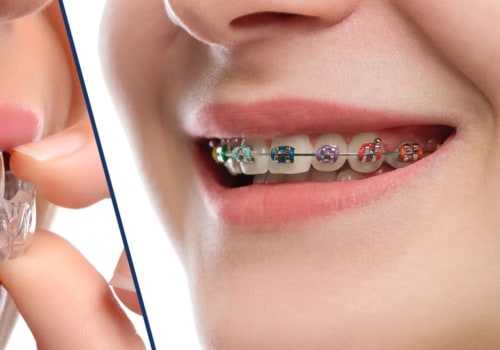 Are braces more expensive than invisalign braces?