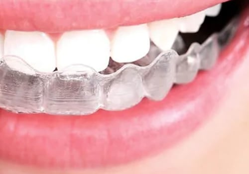 How much does invisalign cost?