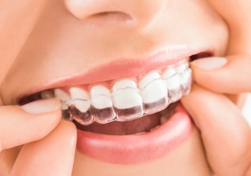 How is invisalign done?
