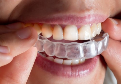 Is it cheaper to get braces or invisalign?