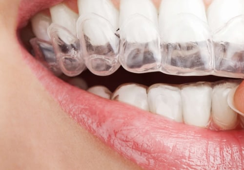 Is invisalign more expensive than traditional?