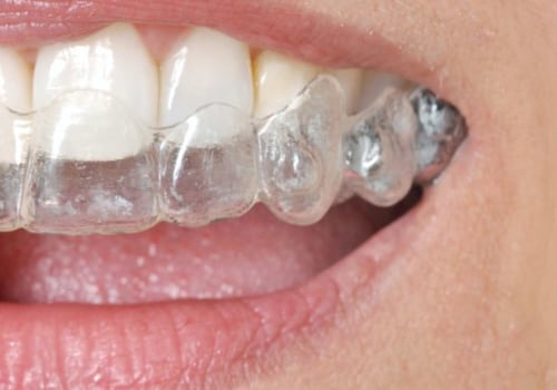 Is Invisalign more painful than braces?