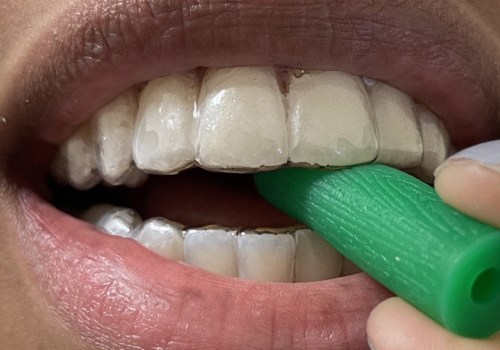 How should invisalign fit in?